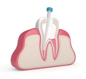 3D render of a root canal in Saratoga