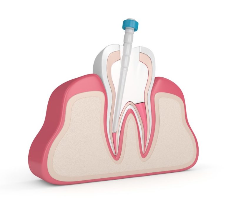 Root Canal in Saratoga Sedation Endodontic Associates Saratoga