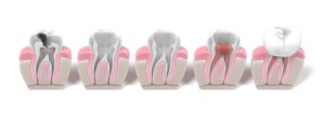 Illustration of tooth at different stages of root canal therapy