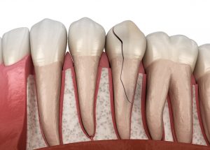 Illustration of cracked tooth in Saratoga between healthy teeth