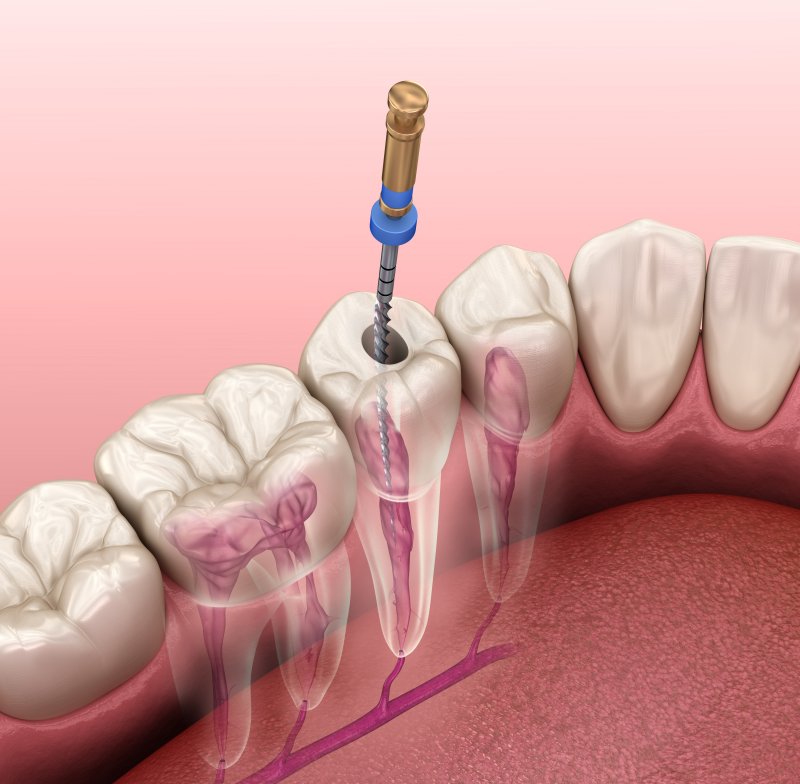 Illustration of root canal being performed