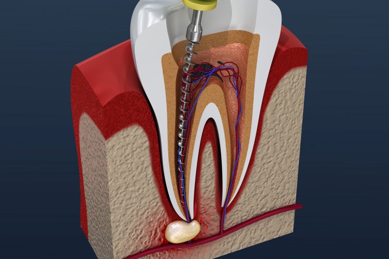 Illustration of model of tooth having root canal performed